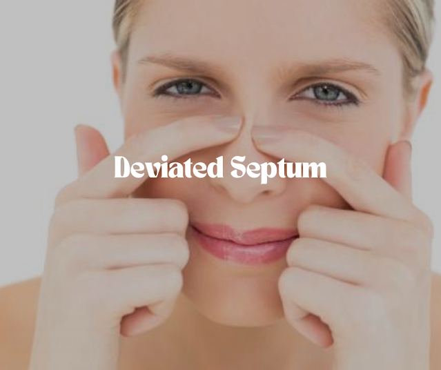 Deviated Septum