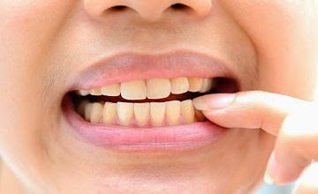 Răng sứ bị ố vàng có tẩy trắng được không?