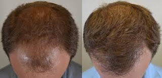 hair transplant in Islamabad