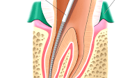 Gutta Percha Root Canal Dangers