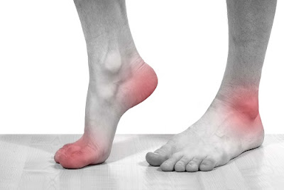 Một vài liệu pháp đơn giản giúp chữa bệnh gout