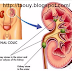 METHODS TO HEAL KIDNEY GRAVEL EFFICIENTLY WITHIN 7 DAYS