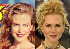 Nicole Kidman Plastic Surgery Before And After