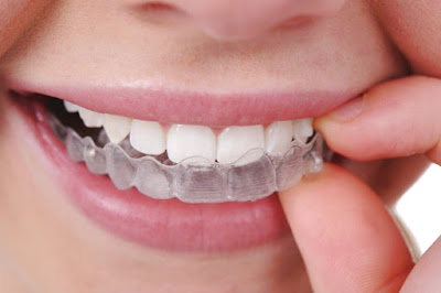 Niềng răng không mắc cài là gì? Một số ưu điểm nổi trội-2