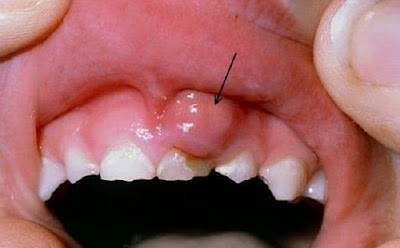 Nguyên nhân gây viêm chân răng có mủ ở trẻ em-1