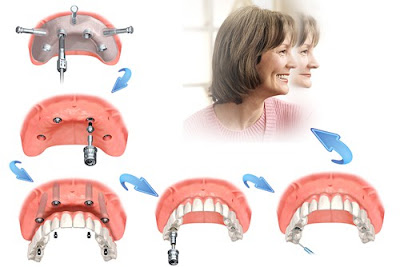 Răng Implant có gây hại cho cơ thể không?