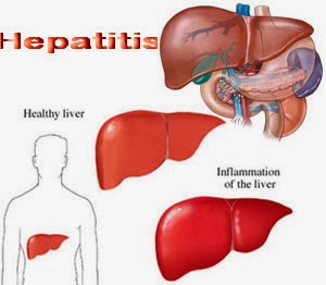 Obat Tradisional Penyakit Hepatitis