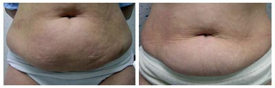 Mesotherapy Before And After