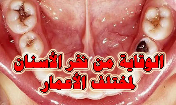 الوقاية من نخر الأسنان لمختلف الأعمار