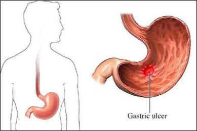 Masalah Dyspepsia (Tak hadam) ~ seribupilihan