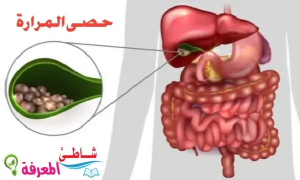 حصى المرارة-الأنواع-الأعراض-الاسباب-الوقاية-العلاج