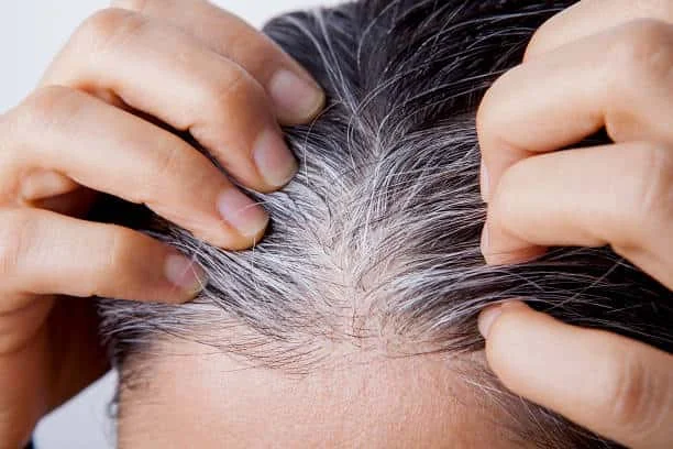 Are your hair also starting to turn white prematurely? Health-Teachers