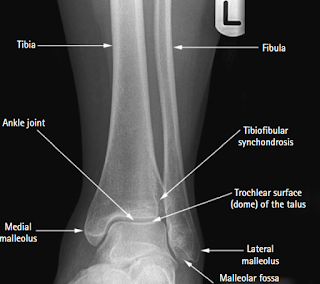 ANKLE MORTISE PROJECTION