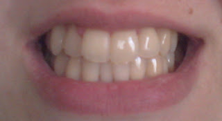 Plus White 5 minute speed whitening system after