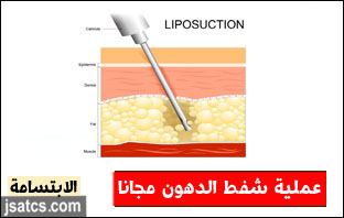 عمليات شفط الدهون مجانا