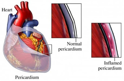 pericarditis