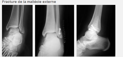 Un médecin du sport vous informe: fractures des malléoles de la ...