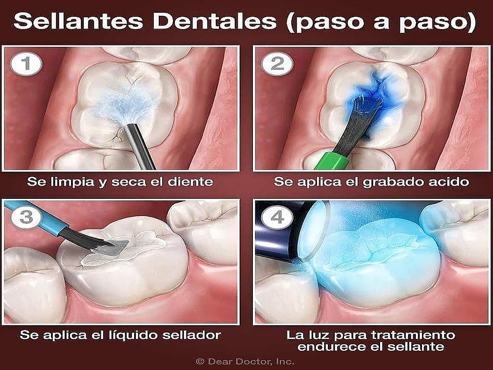 Sellante Dental