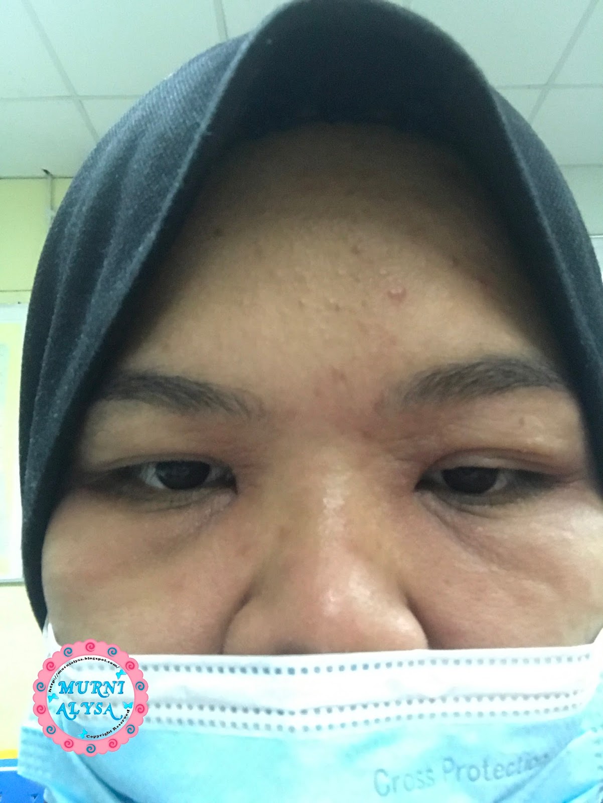 Muka Naik Ruam Teruk Part 1 Alahan Mengandung Di Trimester Ke 2 Coretan Murni Alysa