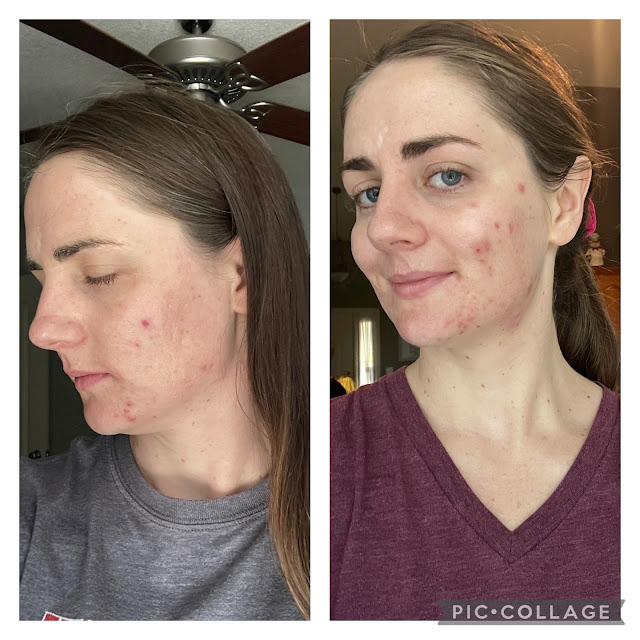 Results from Clearstem Skincare at 4 weeks and 5 weeks