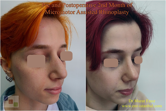 Before and After 2 Months of Rhinoplasty, Postoperative 2nd Month of Nose Job, Before and After Female Nose Aesthetic Surgery
