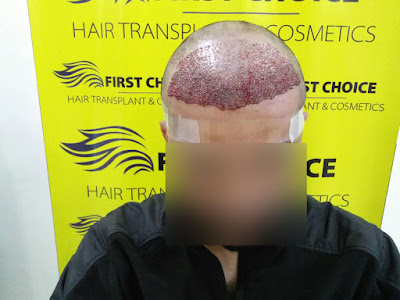 hair transplant result pic