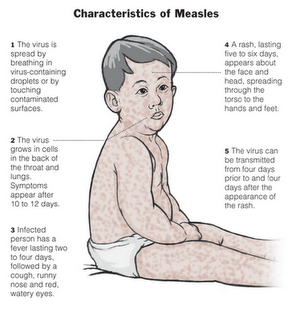 Measles Cure, Home Remedies, Treatments