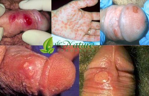 Obat sipilis, obat kenciing nanah, obat gonore