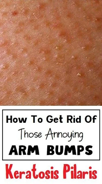 Things You Need to Know About Those Annoying Bumps on your Arms and How to Fix Them Naturally!