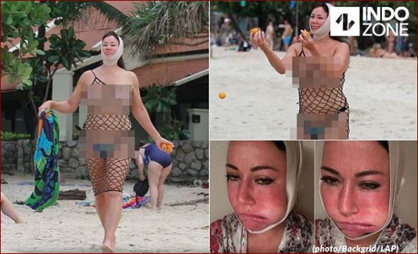 Baru Selesai Operasi Wajah Wanita Ini Malah Pegi Ke Pantai, Wajahnya Jadi Bengkak