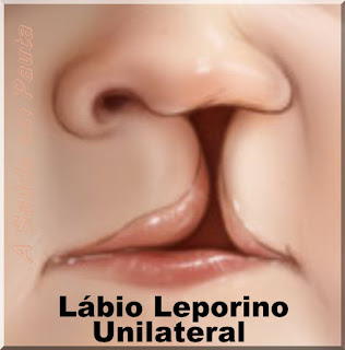 Fissura labial ou lábio leporino unilateral