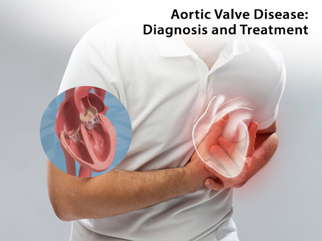 Aortic Valve Disease Explain by Cardiologist