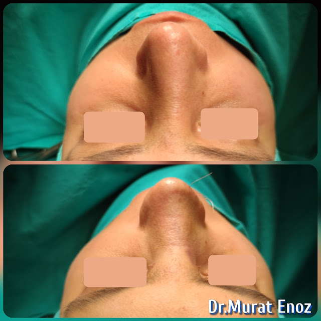 Tertiary Revision Nose Job Rib Cartilage Grafts Removal