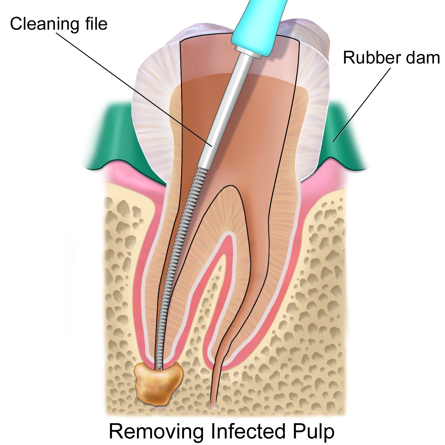 http://www.bestdentistbangalore.com/endodontics/