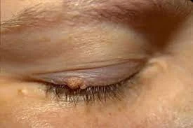 3 biến chứng của bệnh sùi mào gà ở mắt