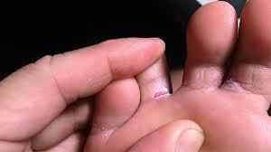 Sea lice between toes treatment
