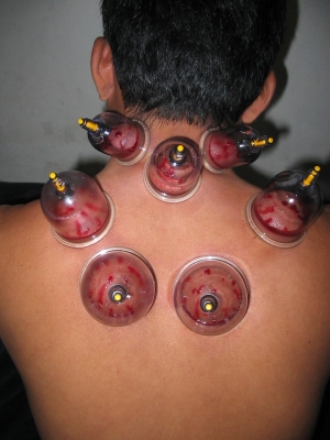 Chinese Cupping Therapy