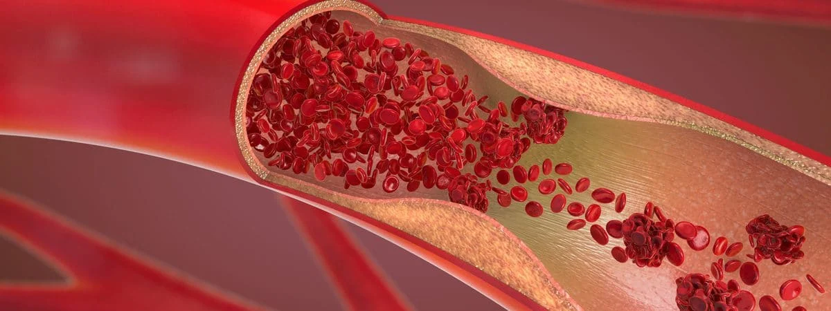 CHOCANTE: Pesquisadores encontram microplásticos em amostras de sangue humano