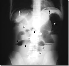 Erect abdomen with intestinal obstruction plus perforation