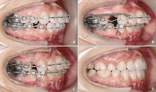 Phương pháp khắc phục răng cửa bị chìa ra ngoài -2