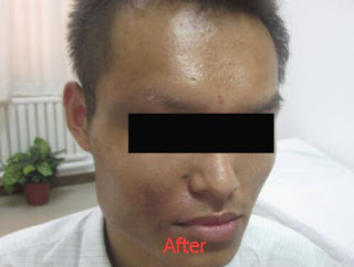 The New Breakthrough Successful Treatment of Vitiligo With 98% by UM-D