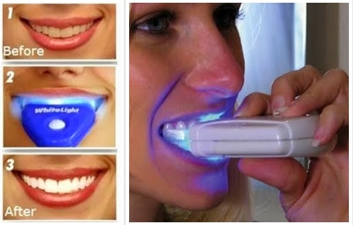 Cara Memutihkan Gigi Secara Alami Tanpa Mengikis Gigi 