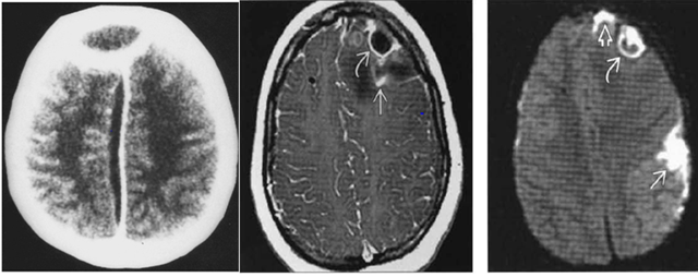 abnormal mri brain