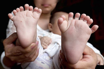Parents of baby born with 16 fingers and 15 toes make desperate plea for help