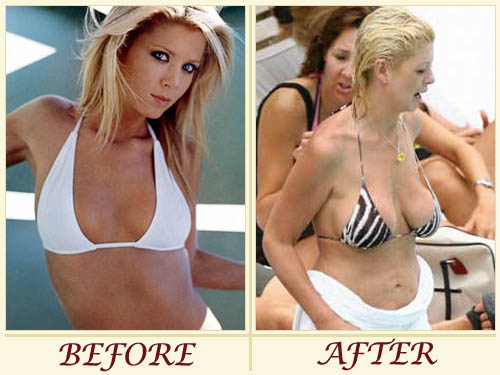 Tara Reid breast implants  Implants breast, Breast actives, Natural breast  enlargement