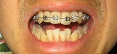 overlapping lower teeth before wearing teeth brace