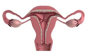 Uterine synechiae Meaning, Symptoms, Causes, Treatment