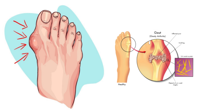 The End of Gout Reviews – Really This Helps You to Fight?