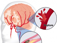 Obat Untuk Stroke Mata