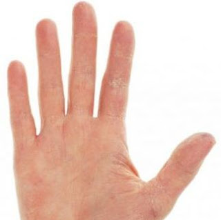 kulit kering kesehatan dibalik tanda tanda pada tangan seseorang